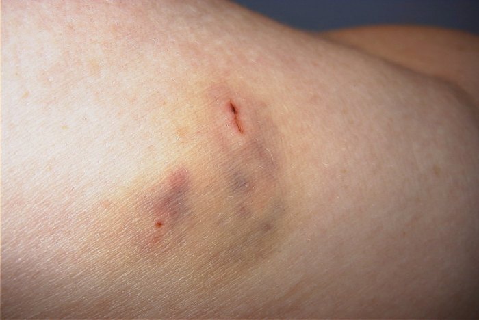 Tick infections wreak devastation lyme